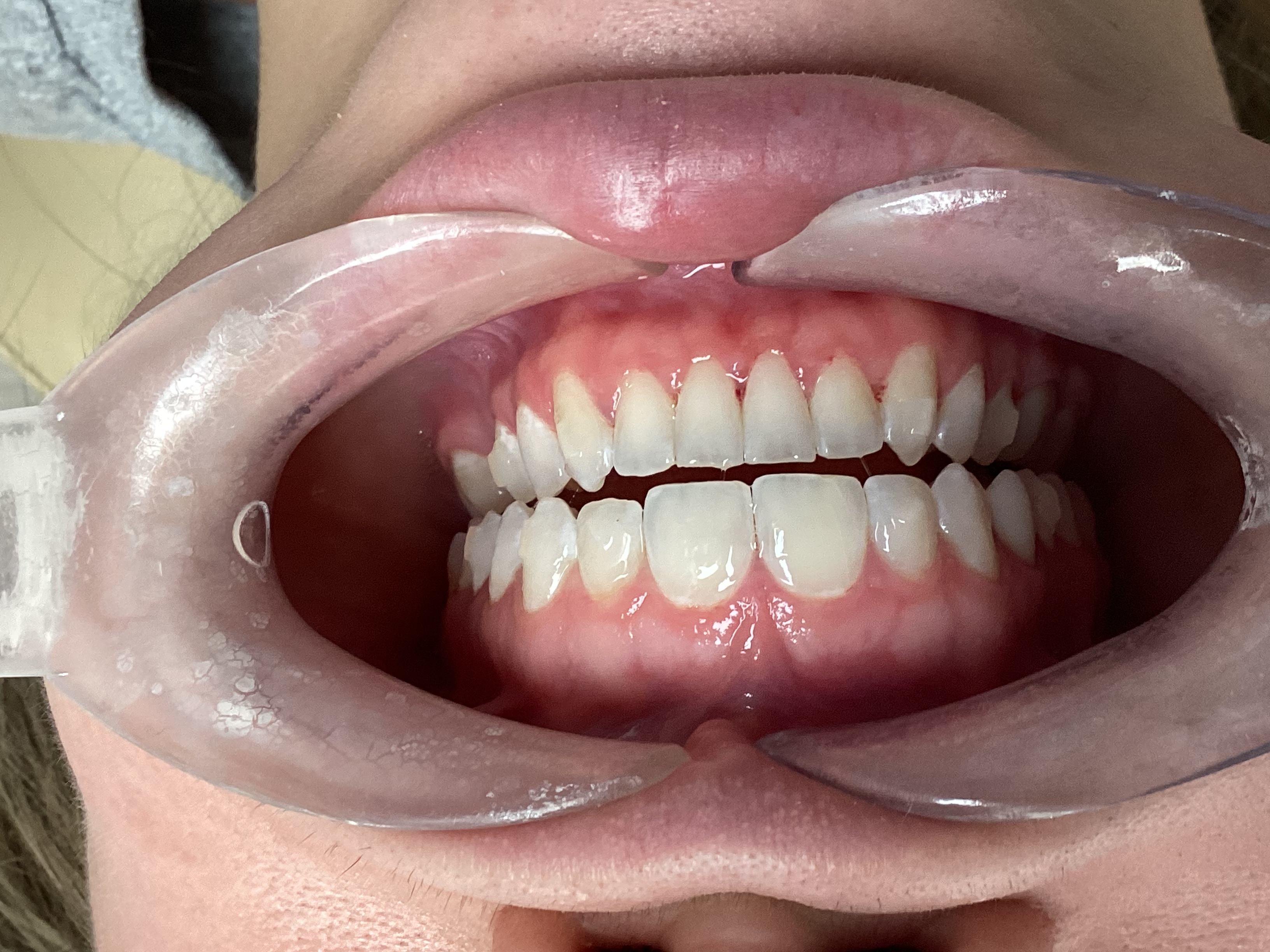 After Invisalign Treatment